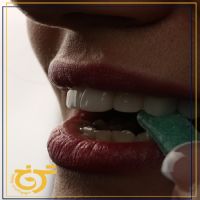 لمینت-در-شرق-تهران-دندانپزشکی-ترنج-و-یا-unique-smile